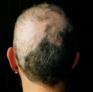 Trichotillomania is another type of hair loss