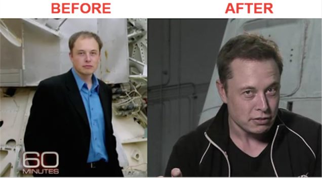 Elon musk hair transplant