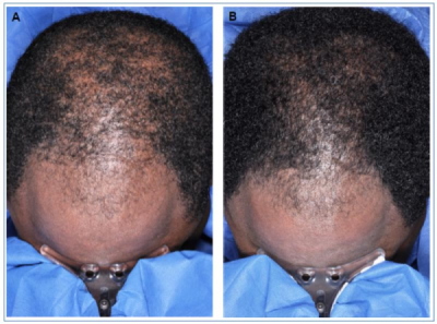 eksplodere opretholde Retningslinier Minoxidil Shedding - 7 Things You Need To Know About the “Dread Shed”