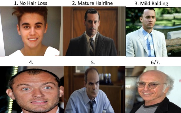 Norwood Scale for Hair Loss - The Most Comprehensive Guide on the Web with  Pictures and 7 Real-World Examples