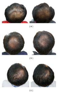 pumpkin seed oil hair loss study, picture