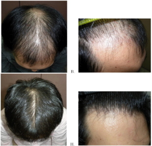 how to get proscar for hair loss