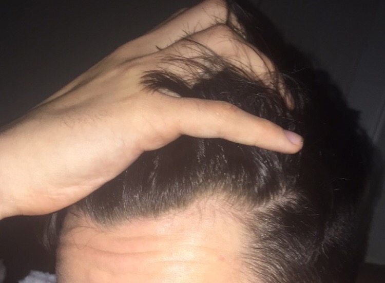 77 Classic Is a v shaped hairline normal for Men