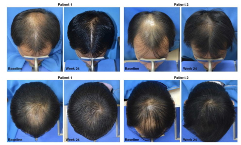 finasteride side effects after 3 months