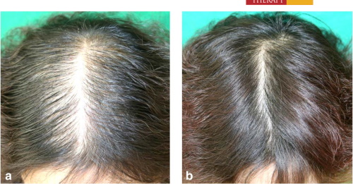 Finasteride 5mg Hair Loss