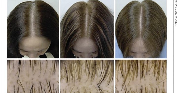 Female Hair Loss is Complicated - Here are 12 Proven Ways to Treat It